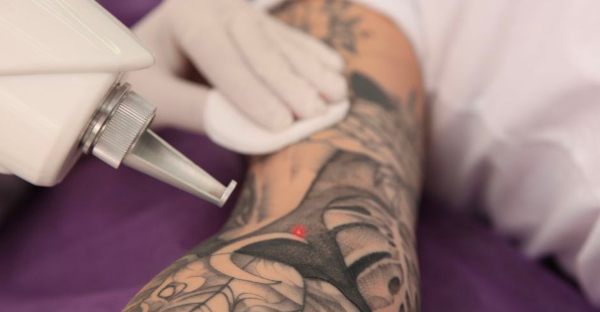 eliminacion tatuajes